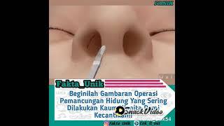 fakta unik  Beginilah gambaran operasi hidung yang sering dilakukan kaum wanita demi kecantikan