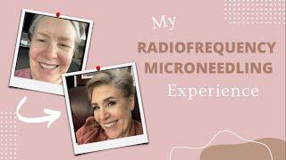 My RF Microneedling Experience