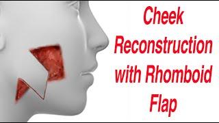 Large Cheek Cancer Excision with Reconstruction Using Rhomboid Flap