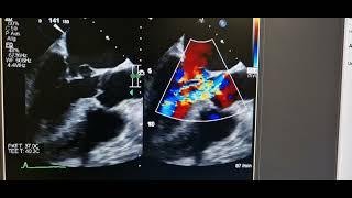 Infective pseudoaneurysm of the anterior mitral valve leaflet