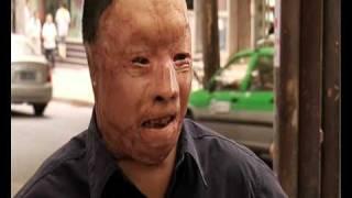 My Shocking Story: Human Face Transplant - The Next Patient