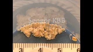 Sialolithiasis-Salivary stone treatment with sialendoscopic pneumatic lithotripsy