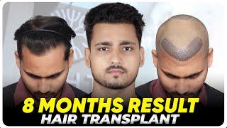 Hair Transplant in Houston | Best Results & Cost of Hair Transplant in Houston