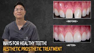 All about aesthetic prosthetics treatment! | Korean Dental clinic | Laminated