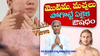 How To Remove Pimples Overnight | Acne Treatment | Dr Manthena Satyanarayana Raju | GOOD HEALTH