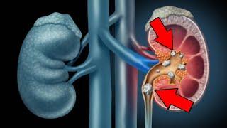 7 Effective Ways To Remove Kidney Stones - What should and shouldn't eat?