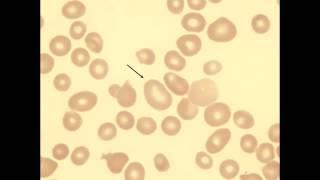 Macro-Ovalocyte & Ringed Sideroblasts