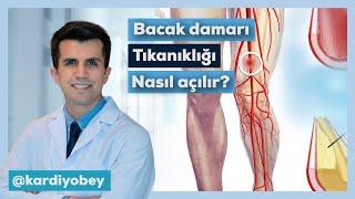 Bacak Damarı Tıkanıklığı Nasıl Açılır?