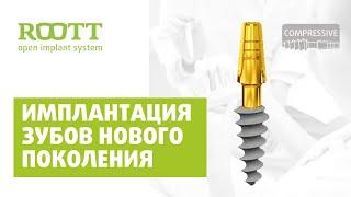 Как устанавливают компрессионные импланты зубов ROOTT (РУТ)? Этапы процесса имплантации зубов