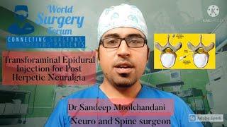 Transforaminal Epidural | Post Herpetic Neuralgia | Dr Sandeep Moolchandani (Neurosurgeon)