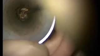 Cerumen impaction removal