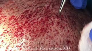 FUE Hair Transplant From Start to Finish