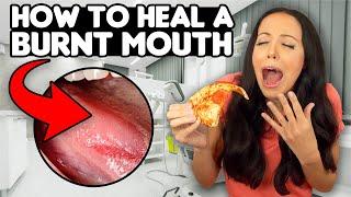 6 QUICK ways to HEAL a BURNT MOUTH