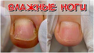 Влажные перепиленные ногти / педикюр / Влажные ноги #Nails #Ногти #педикюр