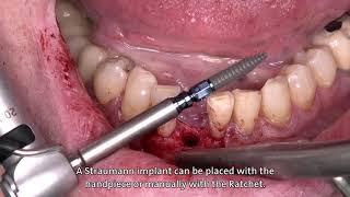Dr. Stefan P. Hicklin:  Straumann® BLT Ø 2.9 mm implant