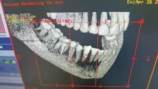 Компьютерная томография зубов и челюсти. 3D КТ зубов. Ортопантомограмма.
