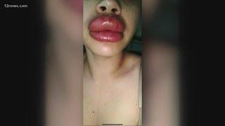 Nearly a dozen Valley women hurt by botched lip injections