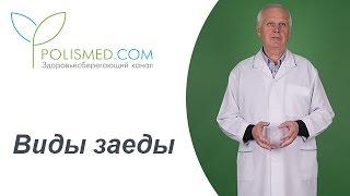 Виды заеды: кандидозная (дрожжевая), сифилитическая. Герпес или заеда?