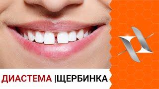 ДИАСТЕМА/щербинка | Почему возникает, как убрать и можно ли оставить?