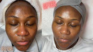 Hyperpigmentation Correction w/ Microdermabrasion