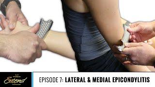 Treating Tennis Elbow with HawkGrips