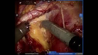 AUA Urology Teaching Videos:Robotic-Assisted Extended Lymph Node Dissection for Pelvic Malignancies