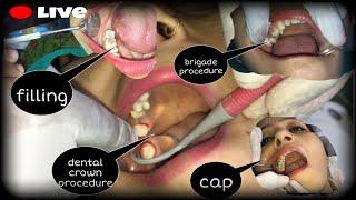 Live RCT filling dental crown bridge procedure full part..