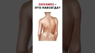 Секреты СКОЛИОЗА - как выправить ПОЗВОНОЧНИК? #меднавигатор #сколиоз #позвоночник