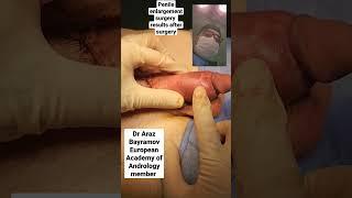 Penile enlargement surgery with excellent results Dr Araz Bayramov www.penilenlargement.com