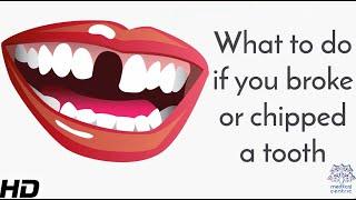 What To Do If You Broke Or Chipped A Tooth?