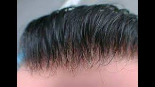 (95 DOL) the THINNEST HAIR PATCH IN THE WORLD 0,01 MM - MOST UNDETECTABLE HAIR SYSTEM