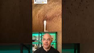 Derm reacts to armpit cyst pops! #dermreacts #doctorreacts #pimplepop #cystpop