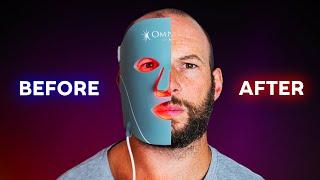 I Tried The Omnilux Mask For 5 Weeks: Surprise?