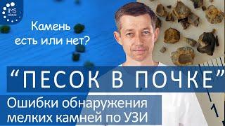 Мелкий камень почки (песок в почке). Почему нельзя доверять УЗИ