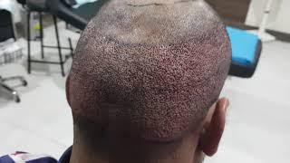 4000+ FUE hair grafts extraction at HairAge by Dr. Zahid Iqbal