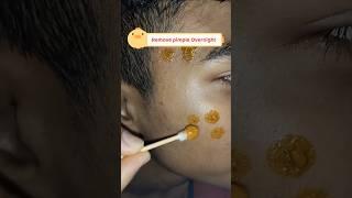 Remove pimple in overnight permanently/Overnight Acne Treatment #ytshorts #viralvedios #acneremoval