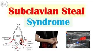 Subclavian Steal Syndrome (“Stealing Blood From Brain”) Risk Factors, Symptoms, Diagnosis, Treatment