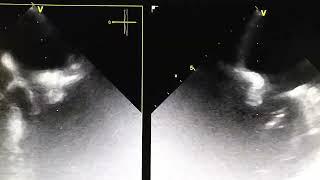 Mitral valve endocarditis