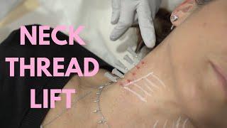 Neck Thread Lift Procedure by Dr Nina Bal  PDO Neck Thread Lift Before and After