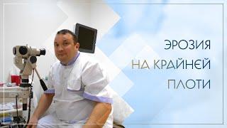  Эрозия на крайней плоти. Клинический случай №84