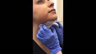 Kybella Treatment | Beleza MedSpa | Austin