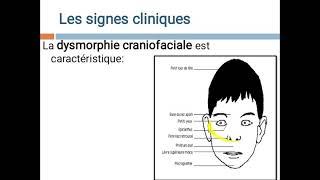 Maladies chromosomiques Pr Ag BELARBI