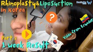 How I came to Korea for Cute Nose and Fit Body from Ecuador | Rhinoplasty, Full Body Liposuction P2