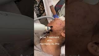 Acne Treatment with Harmony XL PRO || La Mano