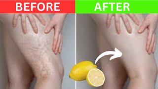 Don't Ignore: This Natural Remedy erases your Varicose Veins!