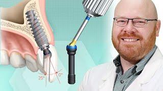 Nobel ASC - Angled Screw Channel