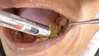 Lower first molar extraction