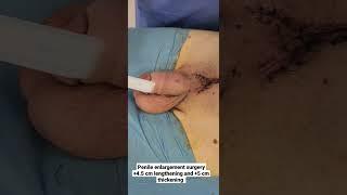 Penile enlargement surgery + 4.5 cm lengthening and + 5 cm thickening Dr Araz Bayramov Penis surgery