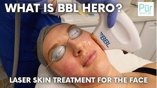 What is BBL HERO? | Laser Skin Treatment For Face | Pūr Skin Clinic