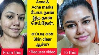 How I cleared my acne! | My skincare routine for Acne & Acne marks | Best products for pimple skin